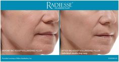 Experience Radiesse Filler in the hands of expert injector Dominique Well in Seattle Sunken Cheeks, Face Rejuvenation, Cosmetic Fillers, Botox Before And After, Hyaluronic Acid Fillers, Aesthetic Dermatology, Wrinkle Filler, Facial Fillers, Injectables Fillers