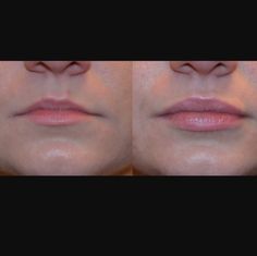 Lips Fillers, Lip Flip, Lips Inspiration, Lip Filler, Botox Fillers, Lip Injections, Natural Lip, Dermal Fillers, Lip Fillers