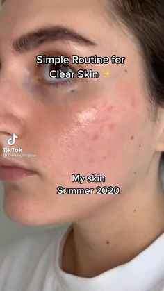 If you are struggling with acne either as a teenager or an adult, here are some of the best acne treatments for your face and body. Teknik Makeup, Clear Skin Fast, Haut Routine, Simple Skincare Routine, Healthy Skin Tips, Skin Care Routine Steps, Skin Routine, Healthy Skin Care