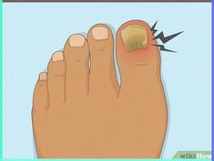 Kick toe fungus to the curb with our comprehensive treatment guideNail fungus, or onychomycosis, is a common skin condition where a fungus infects a part of the nail including the bed, matrix, or plate. Nail fungus can result in cosmetic... Skin Fungus, Mushrooms Growing, Antifungal Cream, Nail Infection, Fungal Nail, Nails Today, Nails Now, Nail Care Routine, 10th Doctor