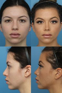 Plastic Surgery Before And After Face, Rhinoplasty Before And After Front View, Nose Plastic Surgery Before After, Rynoplasty Surgery, Rhinoplasty Front View, Nose Tip Surgery Before After, Alarplasty Before After, Nose Surgery Before And After, Subtle Rhinoplasty