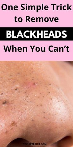 Blackheads Removal Homemade, Beauty Skincare Aesthetic, Skincare Face Masks, Glowing Skin Overnight, Logo Skincare, Skincare Photoshoot, Skincare At Home, Dime Beauty, Remove Blackheads From Nose