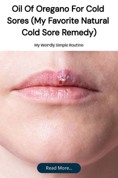 Save this pin to learn how I use oil of oregano for cold sores. If you’re looking for a natural cold sore remedy that packs a punch, this might become one of your favorites, too.