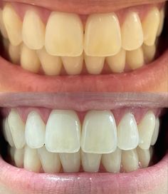 Before and after results of teeth whitening with BURST whitening trays. Teeth Bleaching, Dental Veneers, Dental Art, Smile Makeover, Sonic Toothbrush, Teeth Care, White Teeth