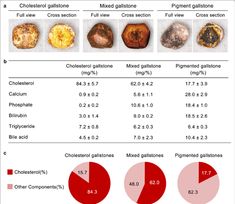 How to Beat GallStones Naturally - DrJockers.com Gall Stones Diet, Gall Bladder Stones Remedies, Gall Stone Diet, Gall Bladder Cleanse, 70s Home Remodel, Liver And Gallbladder Cleanse