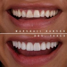 Natural Fangs Teeth, Veneers Before And After, Teeth Shaping, Teeth Inspiration, Perfect Teeth Smile, Natural Veneers, Short Teeth, Loose Teeth, Cosmetic Dentistry Procedures