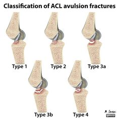 different types of acl in the knee