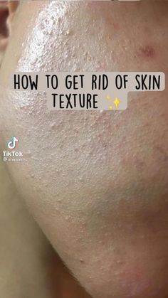 Basic Skin Care Routine, Facial Skin Care Routine, Diy Skincare, How To Get Rid Of Acne, Skin Care Tools, Facial Skin Care, Face Care, Organic Skin Care, Body Oil