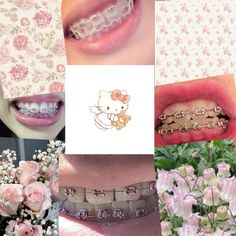 Light Pink Braces Aesthetic, Light Pink Braces Teeth, Pink Braces Aesthetic, Baby Pink Braces, Braces Pink, Pink Power Chain Braces, Perfect Teeth Braces, Brace Ideas, Braces Cute