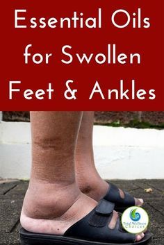 Essential Oil For Swelling, Essential Oils For Inflammation, Water Retention Remedies, Swollen Ankles, Essential Oils For Pain, Essential Oil Remedy, Swollen Legs, Reduce Swelling, Essential Oils Health