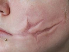 a woman's nose with small bumps on the side of her face and gold piercings