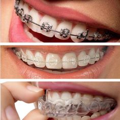 Orthodontics Teeth, Braces Food, Dental Wallpaper, Dental Advertising