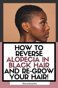 Alopecia Hair Growth, Alopecia Hairstyles, Healthy Natural Hair Growth, Hair Growing Tips, How To Grow Natural Hair, Bald Spot, Hair Remedies For Growth, Regrow Hair, Healthy Natural Hair