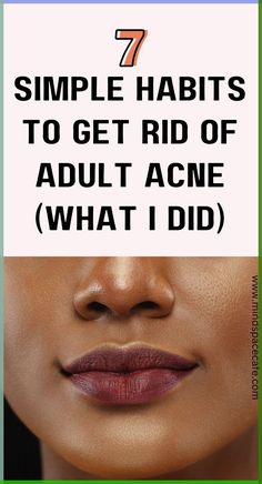 acne prone skin care, acne skincare routine simple, how to get rid of adult acne, how to get rid of acne naturally, acne and pimples home remedies, home remedies for acne, how to get clear skin, cystic acne treatment, how to get rid of acne as an adult, how to remove cystic acne, how to get rid of acne marks, how to get rid of acne naturally, how to clear skin, acne glow up, acne night routine How To Remove Forehead Acne, Remove Acne Marks On Face, How To Get Rid Of Acne Marks, Acne Marks Remedies, Clear Your Skin, Home Remedies For Pimples, Acne Prone Skin Care, Skin Aesthetics, Acne Skincare