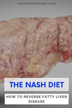 Fatty Liver Diet Plan Foods For Liver Health, Liver Diet Recipes, What Should I Eat, Heal Liver, Tips Diet