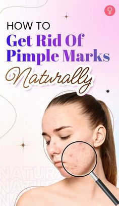 Natural remedies are an effective alternative to surgery or harsh techniques for treating acne scars. These 12 remedies can help lighten your scars gently. Treating Acne, Healthy Juice Recipes, Pimple Marks, Juice Recipes, Cold Sore