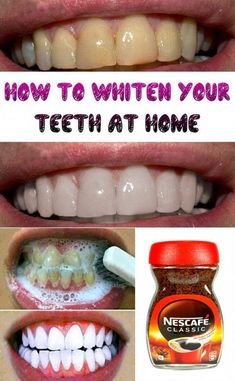 Teeth Whiting At Home, Baby Tooth Decay, Homemade Mouthwash, Alcohol Free Mouthwash, Teeth Whitening Homemade, Teeth Whitening Remedies, Teeth Bleaching, Nice Teeth, Gum Care