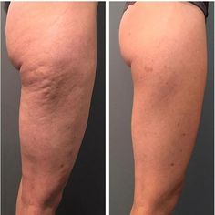 432 likes, 46 comments - bestaestheticinjectors on November 21, 2019: "Repost: @surfacemed #skintightening #cellulitetreatment #cellulitereduction #microneedling #candela #profoundrf #beforeandafter...". Heart Diet, Crystal Makeup, Classy Business Outfits, Adipose Tissue, Health Planner, Natural Pain Relief, Oral Health Care, Health Knowledge, Female Fitness Model