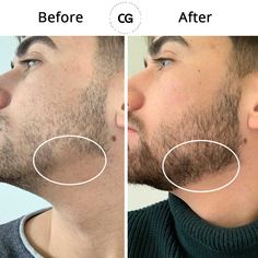 We have great confidence in our products. Enough confidence to offer you a Growth Guarantee. Yep, if you don’t get any results you get your money back. Beard Growth Kit, Beard Tips, Hair Shaver, Black Men Haircuts, Full Beard, Men Haircut Styles, Cool Hairstyles For Men, Beard Growth, Grow Beard