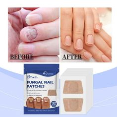 describe: Product Name: Fungus Nail Care Patch Size: 3.5*6.1cm/1.38*2.40" Product color: as shown in the picture Features: 1. Gentle repair and deep nourishment: It uses natural plant essence and mild formula to penetrate deeply into the nail bed, effectively repair damaged nails, promote healthy nail growth, while providing necessary nutrients and moisture to nails and restoring their natural luster. 2. Efficient cleaning, sterilization and anti-itching: Unique fungus-fighting ingredients can q Split Nail Repair, Secret Nails, Nail Problems, Fungal Nail, Efficient Cleaning, Spring Nail Designs, Nail Repair, Damaged Nails, Nail Bed