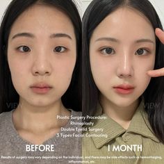 dijbi.com/30-people-who-took-plastic-surgery-to-the-extreme/?utm_source=pinterestw28&utm_medium=link&utm_campaign=vape Korean Nose Job, Korean Nose, Korean Surgery, Jaw Reduction Surgery, Change Appearance, Nose Surgery Rhinoplasty, Ethnic Rhinoplasty, Plastic Surgery Korea, Plastic Surgery Fail