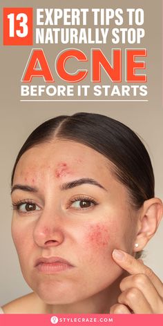 Acne and pimples are not easy to deal with, and no one prefers to go through that ordeal. So, is not it better we prevent them? But how to prevent pimples and acne? Several factors cause them, and you need to follow a systematic skincare routine to prevent acne and pimples.