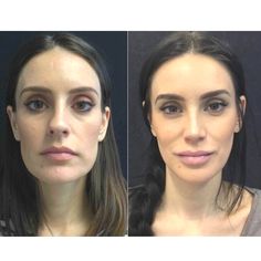 Face Filler Transformation, Filler Transformation, Worst Makeup, Jaw Reduction Surgery, Nose Surgery Rhinoplasty, Plastic Surgery Fail, Under Eye Fillers, Rhinoplasty Nose Jobs