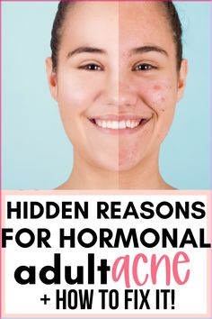 Get rid of acne without medication and completely naturally. Here are the unexpected culprits for hormonal adult acne!. #acne #acnetreatment #naturalacnetreatment Prevent Acne Tips, Deep Acne Remedies, How To Get Rid Of Blemishes, Acne Breakout Chart, Makeup Ideas For Acne Skin, How To Help With Acne, Natural Remedies For Cystic Acne, Acne At Age 40, Bad Acne Remedies