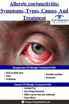 Allergic conjunctivitis usually happens when a person’s eyes make contact with an allergen, which makes the body’s system to overreact. Conjuctivita Eye, Best Eye Drops, Swollen Eyelid, Mthfr C677t, Eyes Health, Eye Diseases, Eye Vision, Eye Pain, Natural Face Cleanser