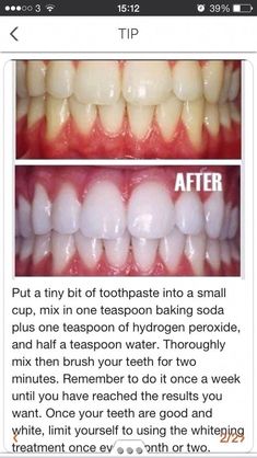 Natural Teeth Whitening Diy, Diy Coconut Oil, Teeth Whitening Remedies, Teeth Whitening Diy, Charcoal Teeth Whitening, Baking Soda Shampoo, Natural Teeth Whitening, Natural Teeth, Oral Health Care