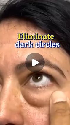 Eliminate Dark Circles Under Eyes, Dark Eye Circles How To Get Rid Of, How To Cover Up Dark Circles Under Eyes, Black Circles Under Eyes, Preparation H For Eyes, Watery Eyes Remedy, Dark Rings Under Eyes