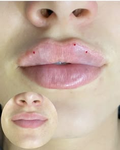 Lip Filler Russian, Russian Lip Filler, Russian Lips, Lip Surgery, Lips Inspiration, Botox Lips, Face Mask Aesthetic, Cheek Fillers