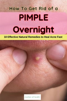 Tired of dealing with pesky pimples that keep coming back? Discover our simple, easy-to-follow guide on 'How To Get Rid of a Pimple Overnight' and transform your complexion from dull to radiant in no time. Say goodbye to embarrassing pimples and hello to clear, glowing skin! Overnight Pimple Remedies, Zit Remedy, Stubborn Acne, Pimples Under The Skin, Fresh Aloe Vera Gel, Pimples Overnight, Fresh Aloe Vera