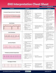 Use this EKG interpretation cheat sheet that summarizes all heart arrhythmias in an easy-to-understand fashion. Heart Rhythms Nursing, Paramedic Cheat Sheet, Nremt Study Cheat Sheets, Easy Ekg Interpretation Cheat Sheets, Arrhythmias Nursing Cheat Sheets, Ekg Rhythms Cheat Sheets, Pharmacology Cheat Sheet Nursing, Arrhythmias Notes