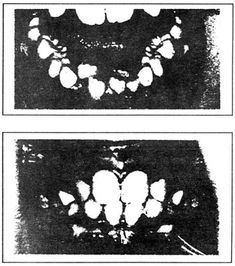 two different views of teeth in black and white