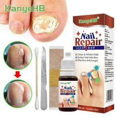 Nail Repair Fluid Toenail And Nail Solution Toenails And Nails Repair Damaged And Discolored Nails 10ML Features: Its ingredients dry quickly and form a mask to the surface of the nails and the nails. Results: Not does it strengthen brittle nails, it also helps to damaged and nail appearance. EASY TO APPLY: The easy-to-use brush applicator helps to apply clear liquid to affected areas to nail growth for a smooth, rosy and shimmery finish. Gentle: Natural Toenail and Nail Repair Pen is effective Dark Toenails, White Patches On Toenails, Repair Split Nail, Nail Bed Damage Repair, How To Fix A Broken Nail, Hack For Toe Separator Nail Polish, Nails Repair, Nail Infection, Fungal Nail