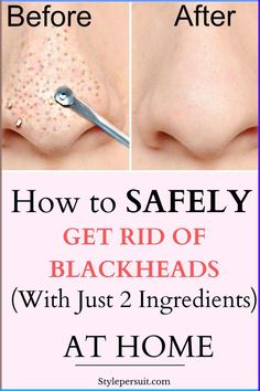 You can easily get rid of these blackheads by using natural or home remedies for blackhead treatment. Click to read How to get rid of blackheads diy| The best blackheads removal on nose| get rid of blackhads on face| get rid of blackheads on nose| how to get rid of blackheads naturally ... Natural Blackhead Remover, Remedies For Blackheads, Reverse Wrinkles, Remove Blackheads From Nose, How To Remove Blackheads, Facial Massage Techniques, Overnight Skin Care, Blackhead Remover Diy