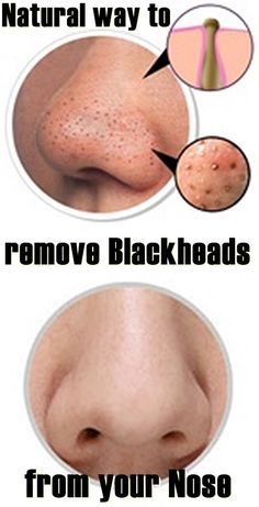 How to remove blackheads at home Acne On Nose, Nose Pimples, Black Head Remover, Remove Blackheads From Nose, Blackhead Remover Diy, Black Head Remover Mask, Brown Spots On Skin, Spots On Skin