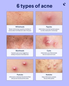 Nodule Acne, Acne Types, Different Types Of Acne, Forehead Acne, Pimples Under The Skin, Natural Acne Remedies, Types Of Acne