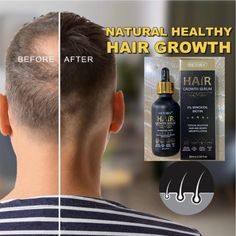 Hair Growth Serum & 5% Minoxidil Treatment For Women & Men For Stronger Thicker Longer Hair Stop Thinning & Hair Loss With This Wonderful Natural Hair Growth Thickening Treatment. Expire: 19/05/2027 New With Box. Shipping Within 24 Hours On Business Days. Thicker Longer Hair, Biotin Hair Growth, Hair Color Black, Long Hair Color, Hair Growth Serum, Healthy Natural Hair, Coconut Oil Hair, Longer Hair, Growth Serum