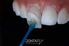 Best Dental Clinic in Turkey | Smile makeover Dental Pictures, Misaligned Teeth, Dental Photography, Veneers Teeth, Porcelain Veneers, Dental Veneers, Dental Art, Dental Cosmetics, Dental Crowns