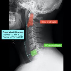 an x - ray shows the location of the ribs in this image, and is labeled with