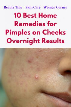 Are you concerning about home remedies for pimples on cheeks? Pimples on cheeks kill face beauty and create dirty impression of personality. White Pimples On Face, Cheek Pimples, Remedies For Pimples, Cheek Acne, Peroxide For Acne, Home Remedies For Pimples, Pimples Under The Skin, Acne Prone Skin Care, Tips For Oily Skin