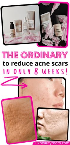 7 Best Products from The Ordinary for Acne Scars Skincare Advertising