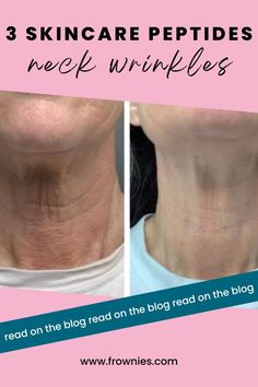 side by side, before and after image of woman's chin and neck to show the improvement of neck wrinkles Plant Based Skincare, Skincare Products, Promo Codes