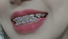 Brackets Aesthetic, Orthodontic Appliances