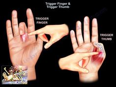 Trigger Thumb Remedies, Trigger Thumb Exercises, Trigger Finger Remedies, Thumb Pain Relief, Trigger Finger Exercises, Hand Health, Arthritic Pain, Finger Exercises, Adaptive Equipment