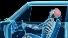 Effects of whiplash in a car accident Spine Injury, Post Concussion Syndrome, Chiropractic Therapy, Soft Tissue Injury, Chiropractic Clinic, Neck Injury, Ligament Injury, Spinal Injury, Neck And Back Pain