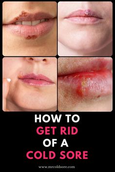 How to get rid of a cold sore fast