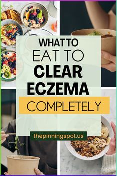 Unveil the secrets to a skin free from eczema with this eczema diet guide I used to heal my eczema. Discover the power of the skin foods in getting rid of eczema, understand the benefits of a skin diet and learn about the best eczema diet to eat. Equip yourself with knowledge on natural eczema treatments and start your journey to heal eczema from the inside out. This guide provides essential insights into the foods you should include and those you should avoid for better skin health. Meals For Skin Health, Foods To Avoid For Excema, Nutrition For Skin Health, Natural Remedy For Excema, Excema Treatments Diy, Excema On Face Skincare, Excema Diet For Kids, Natural Remedies For Excema, Excema Diet